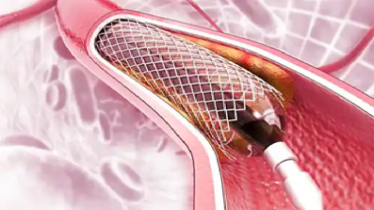 হার্টের রিংয়ের দাম অর্ধেকে নামলো, প্রজ্ঞাপন জারি 