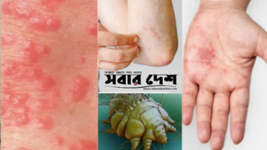 মেঘনায় ছোঁয়াচে স্ক্যাবিসের উদ্বেগজনক বিস্তার